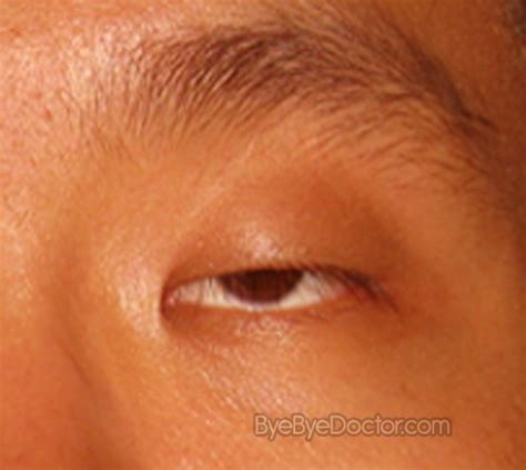 Swollen Eyelid Symptoms Symptoms Causes Treatment And Prevention Of