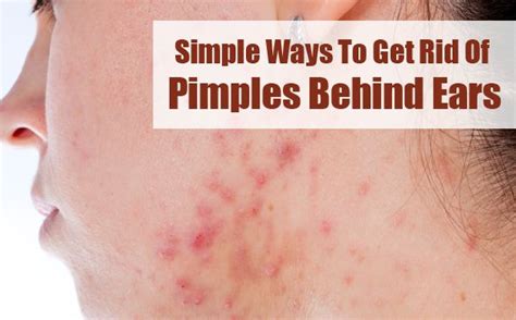 Pimples Behind The Ears 6 Home Remedies And Causes How To Get Rid Of