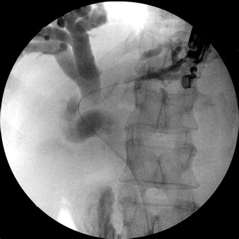 Eus Guided Biliary Drainage Made Safer By A Combination Of