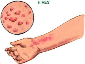 Medically reviewed by harshil matta, do — written by sy heat rash, also known as prickly heat, summer rash, or wildfire rash, is common and can be heat rashes are not often dangerous, but if symptoms last longer than a few days or signs of an. Hives - Home Remedies, Causes, Symptoms, Treatment, Diet