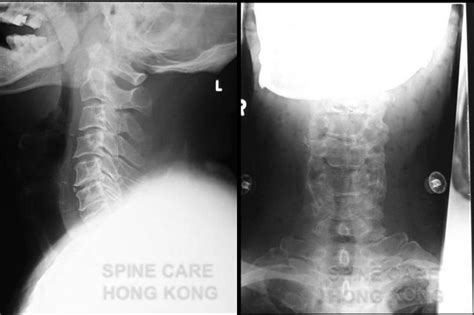 Upper Cervical Spine Fractures And Dislocations Dens Fracture Screw