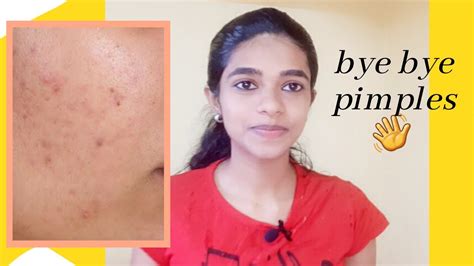 How To Remove Pimples By Easy Home Remedy Youtube