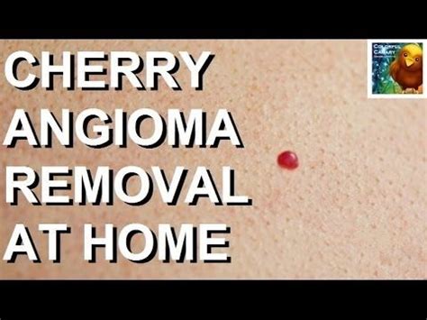 Campbell de morgan spots are also called cherry angioma or hemangioma. Cherry Angioma Removal (Hemangioma, Campbell De Morgan ...