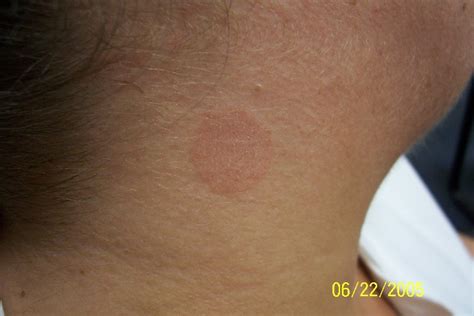 Ringworm On Neck Pictures Photos