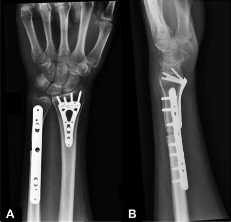 Computer Assisted 3 Dimensional Planned Corrective Osteotomy For