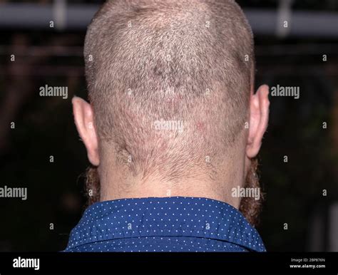 Back View Of A Bald Man Suffering From Scalp Acne Red Itchy Dots On