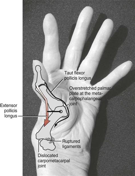 Forearm Wrist And Hand Musculoskeletal Key