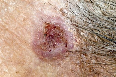 Basal Cell Skin Cancer On The Temple Stock Image C0167366