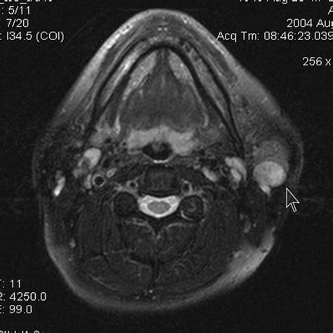 Warthins Tumors Of Parotid Glands Eurorad