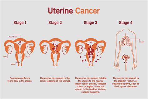 Uterine Endometrial Cancer Types Risk Factors Symptoms And Treatment