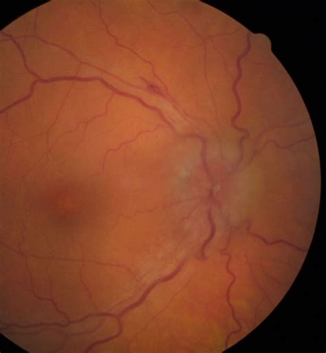 Causes Of Disc Edema Unilateral Vascular Infectious Diabetic Papillopathy