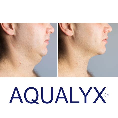 Aqualyx Treatment Fat Dissolving Injections