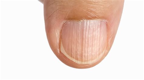 O czym świadczą pionowe bruzdy na paznokciach
