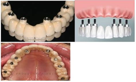Qué son las prótesis dentales fijas Dentisalut