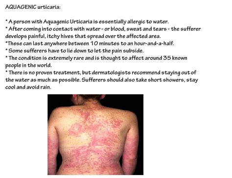 Pin By Medicosdelight On Medicosdelight Urticaria Chronic Hives Person