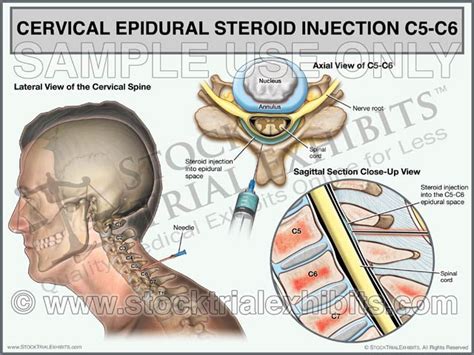 C5 C6 Cervical Epidural Steroid Injection Trial Exhibit Male Stock