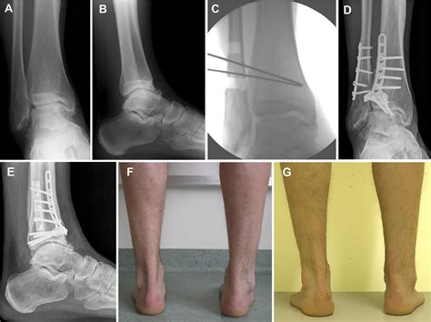 Treatment Of Posttraumatic Varus Ankle Deformity With Supramalleolar