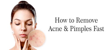 How To Remove Acne And Pimples Fast Medplusmart