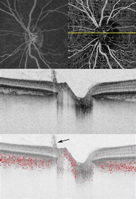 Doppler Optical Coherence Tomography OCT Imaging Of The Left Eye Of Download Scientific