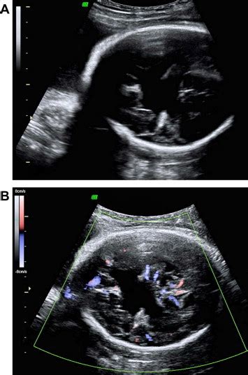 Fetal Head Ultrasound At 33 Weeks Gestation Revealed Irregular