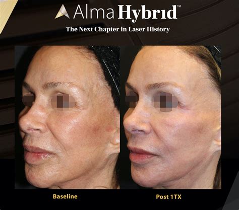 Improve The Quality Of Your Skin With Alma Laser Star Medispa Star