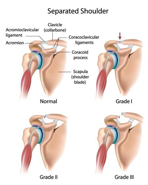 Pictures Of Acromioclavicular Joint