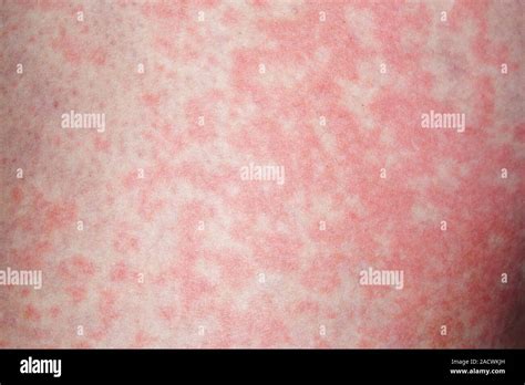 Hives Weals On The Skin Of An 18 Year Old Female Patient Caused By