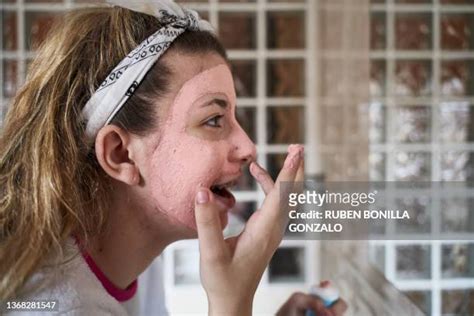 Rosacea Face Photos And Premium High Res Pictures Getty Images