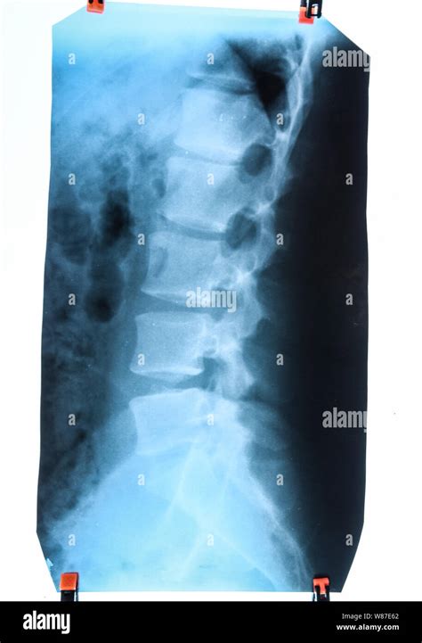 Radiografía De La Columna Lumbar La Columna Vertebral En Los Rayos X