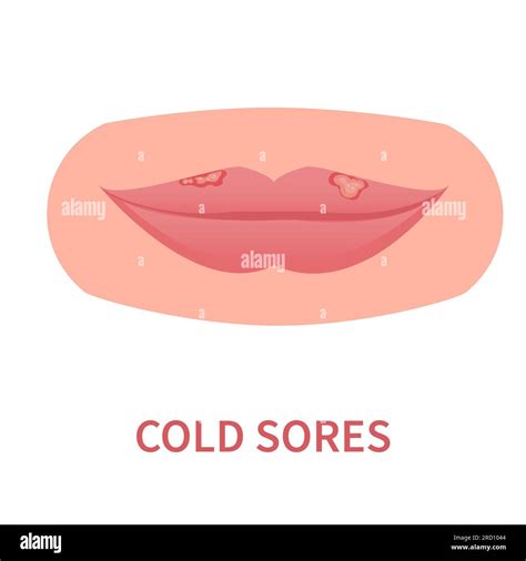 Cold Sore Lips Stock Vector Images Alamy