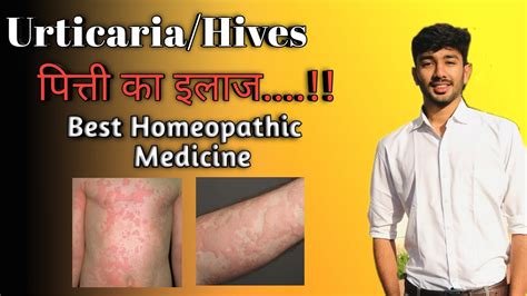 Urticaria Hives Best Treatment By Homeopathic Medicine Youtube