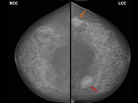 Atlas Of Breast Cancer Early Detection