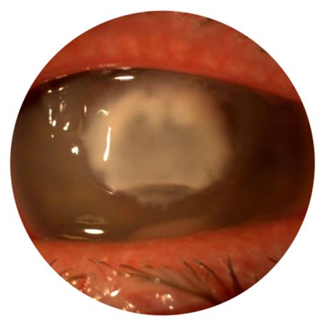 Corneal Ulcers — Moyes Eye Center