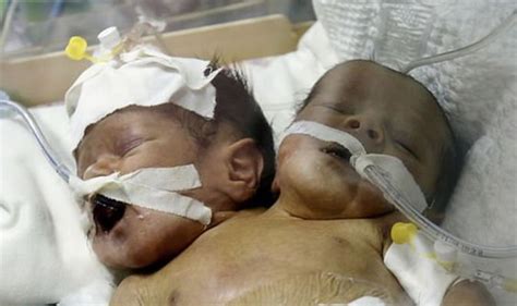 Rare Conjoined Twins Born In Yemen First Pictures Of ‘unique Case