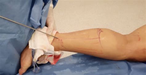 Arquivos lipoaspiração nas pernas Cirurgião Vascular