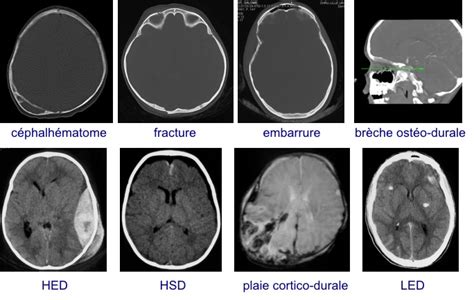 Les Traumatismes Crâniens Chez Lenfant Neurochirurgie Pédiatrique