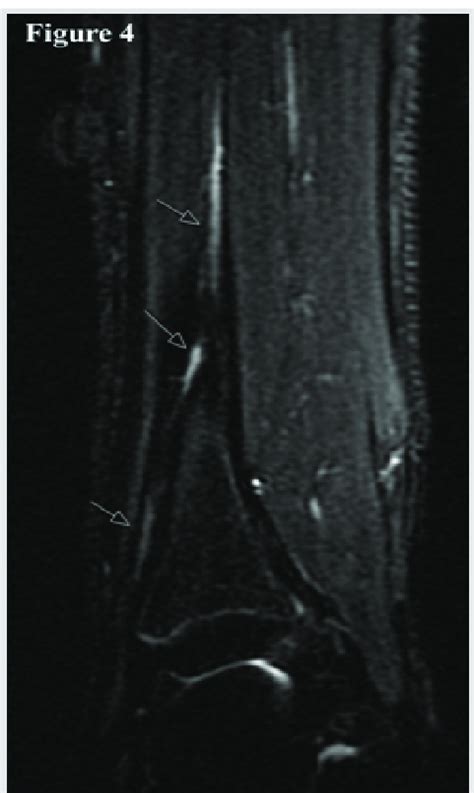 Magnetic Resonance Imaging Showing The Anterior Tibial Artery And Deep