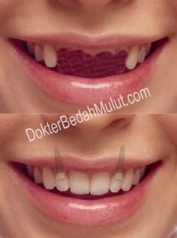 Bagaimana Cara Tanam Implan Gigi Dokter Bedah Mulut