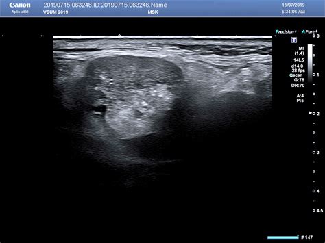 Vietnamese Medic Ultrasound Case 559 Warthin Tumor Dr Phan Thanh Hai