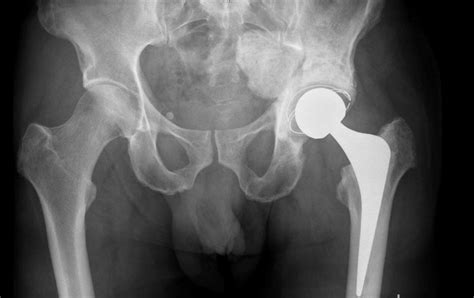 What Is A Total Hip Replacement Paddington Paddo Physio
