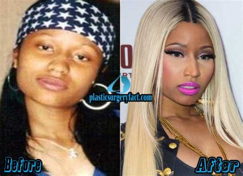 nicki minaj plastic surgery before and after photos