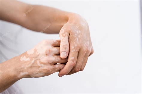 Premium Photo Hands With Vitiligo Skin Pigmentation On White