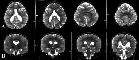 Semilobar Holoprosencephaly A And B Axial And Coronal T2 Showing