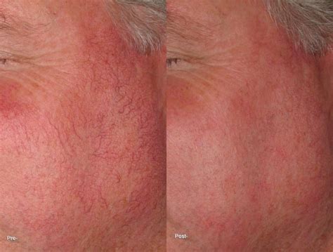 Facial Redness Treatments Plymouth And Edina Mn Zel Skin