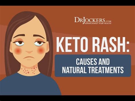 Keto Rash Causes And Natural Treatments
