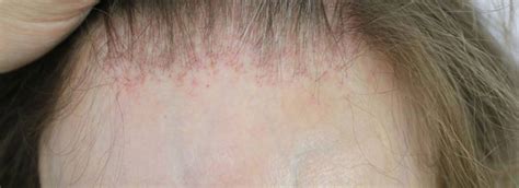 The 3 Common Types Of Scarring Alopecia And How To Treat Them