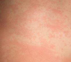 What does a food allergy rash look like. heat bumps on babies - pictures, photos