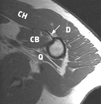 Pectoralis Tear - Radsource