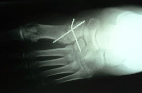X Ray Aspect Of At The First Postoperative Day Of The Lesion Showed By