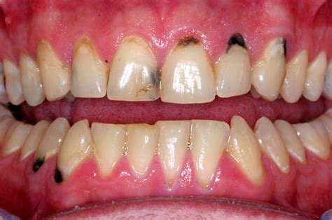 Left untreated it can inhibit your roses from blooming. Black Spot on Gums Near Tooth: Learn What Causes Dark ...